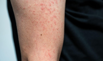 Primavera do Leste confirma sexto caso de sarampo; criança não estava vacinada