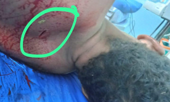 Homem acusado de estupro é espancado e levado ao hospital em Pontes e Lacerda