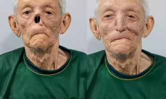 Idoso de 80 anos ganha prótese de nariz após câncer de pele em Cuiabá