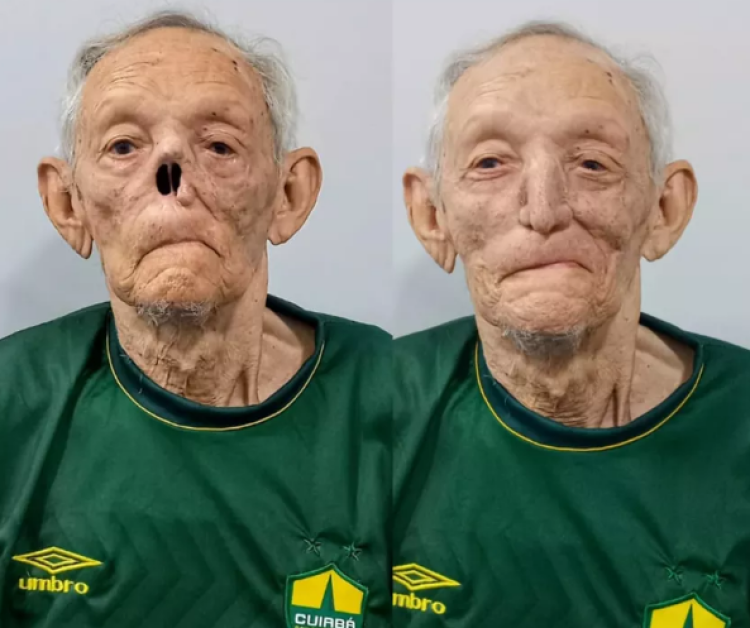Idoso de 80 anos ganha prótese de nariz após câncer de pele em Cuiabá