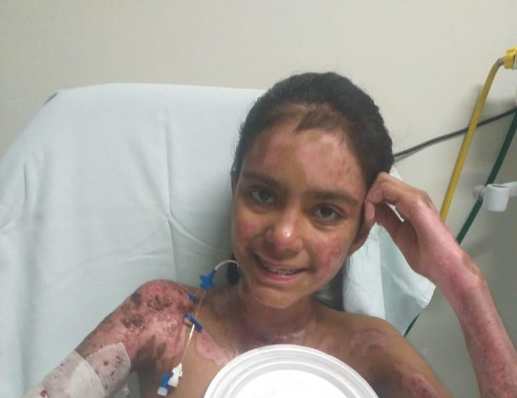 Menina que teve 84% do corpo queimado em Pontes e Lacerda se recupera em Cuiabá