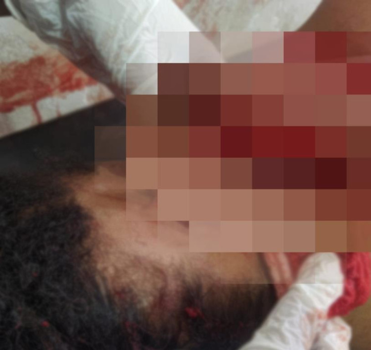 Mulher tem parte da orelha arrancada com golpe de facão durante briga em Pontes e Lacerda