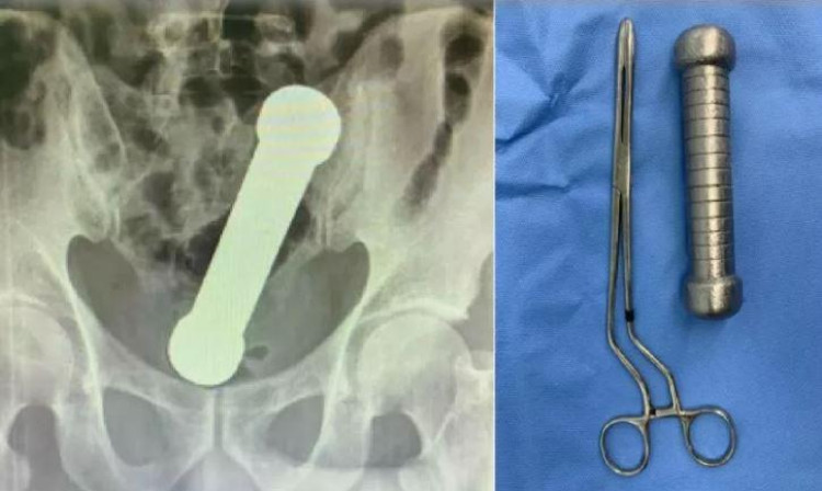 Repercutiu no mundo : Homem fica com peso de academia de 2 kg preso no reto